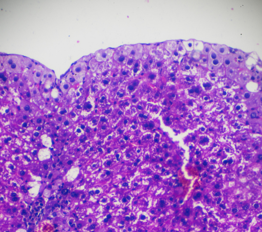 Biopsia hepática transyugular