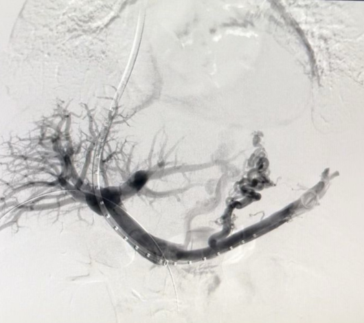 Derivación intrahepática transyugular portosistémica (TIPS)